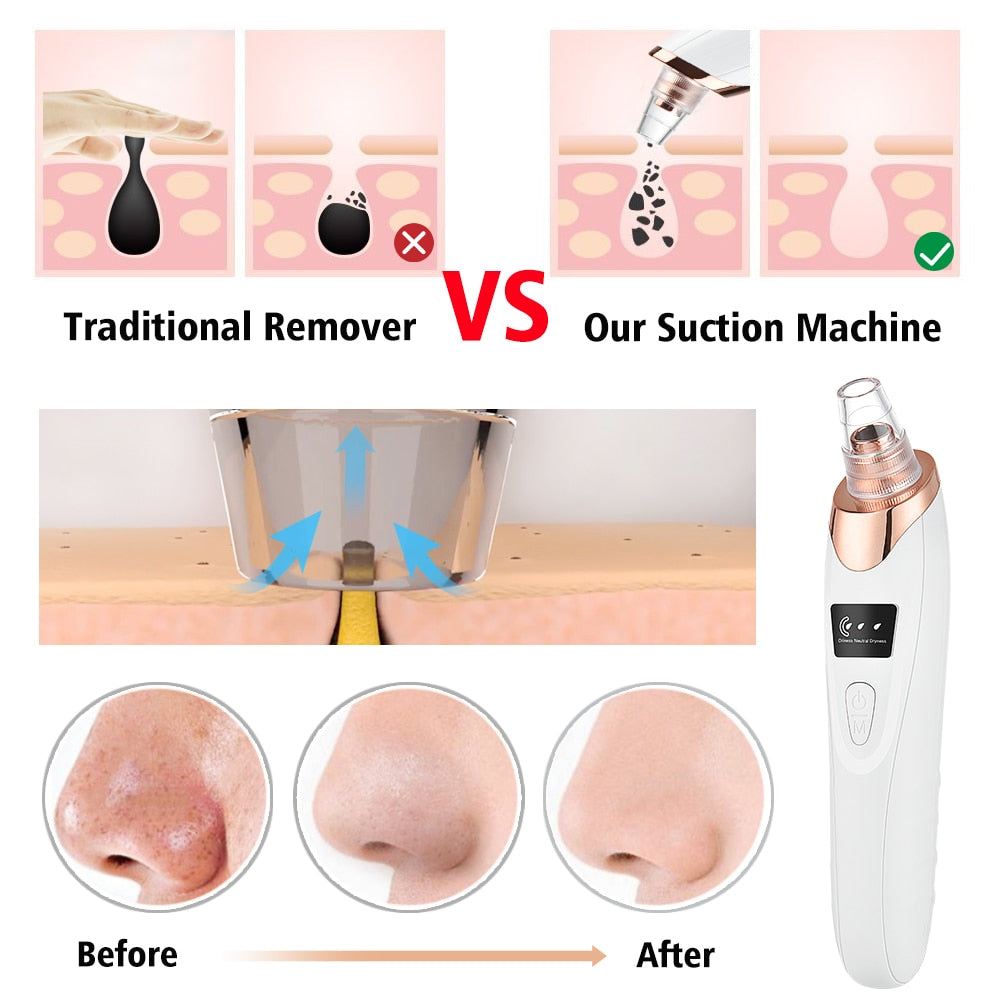 Vacuum Electric Blackhead Remover Cleaner